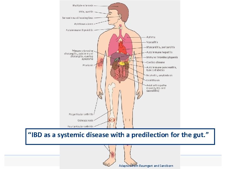 “IBD as a systemic disease with a predilection for the gut. ” Human touch