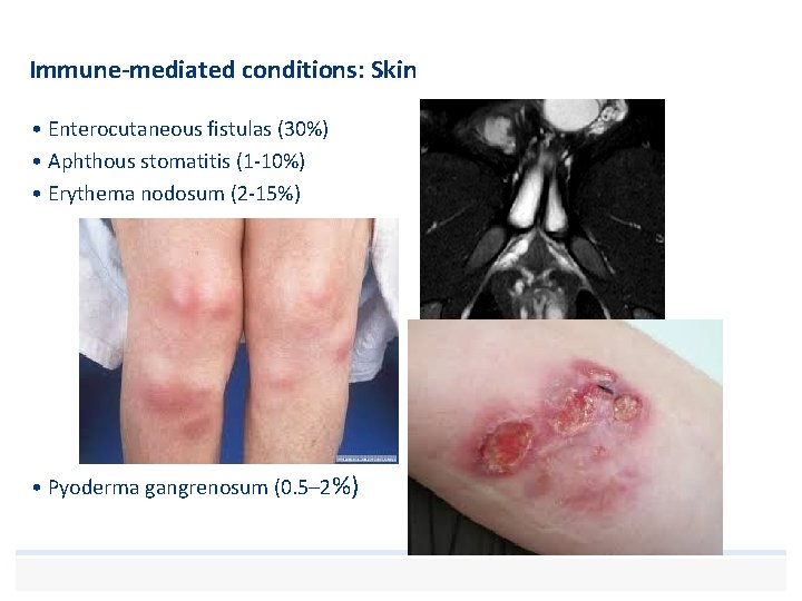 Immune-mediated conditions: Skin • Enterocutaneous fistulas (30%) • Aphthous stomatitis (1 -10%) • Erythema