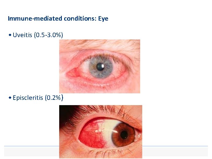 Immune-mediated conditions: Eye • Uveitis (0. 5 -3. 0%) • Episcleritis (0. 2%) 