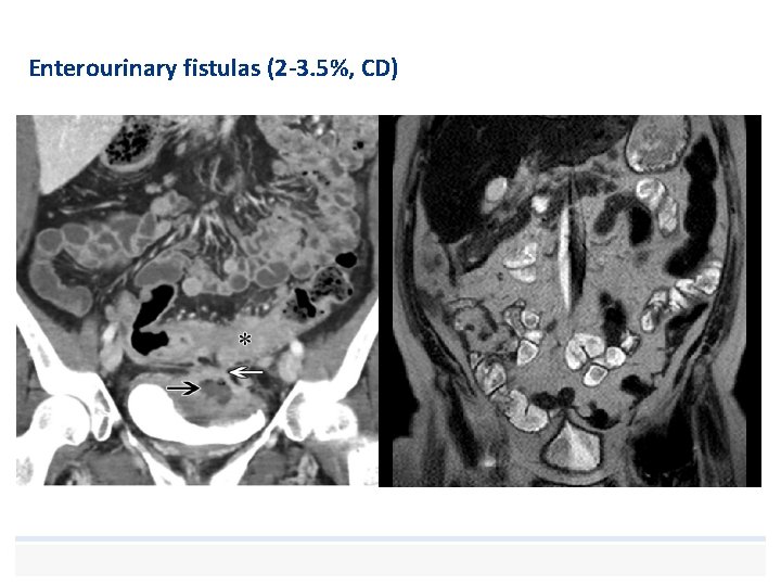 Enterourinary fistulas (2 -3. 5%, CD) 