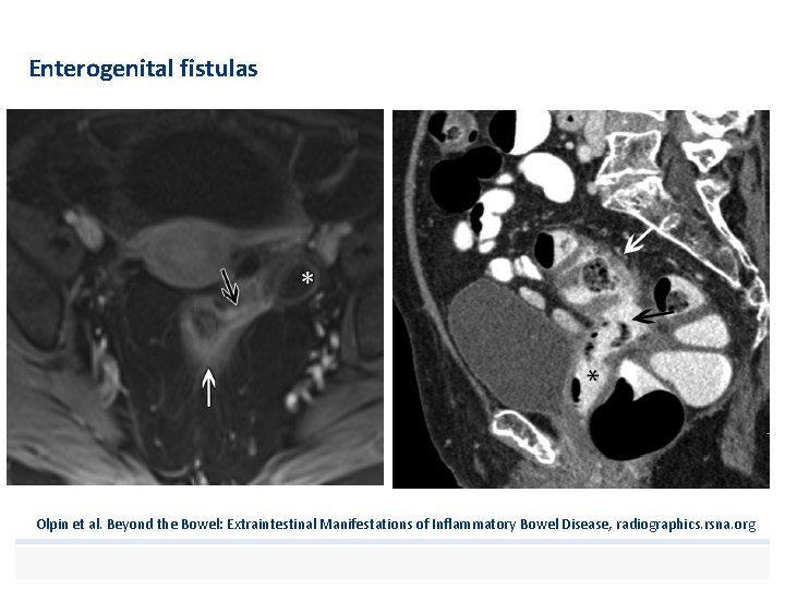 Enterogenital fistulas Olpin et al. Beyond the Bowel: Extraintestinal Manifestations of Inflammatory Bowel Disease,