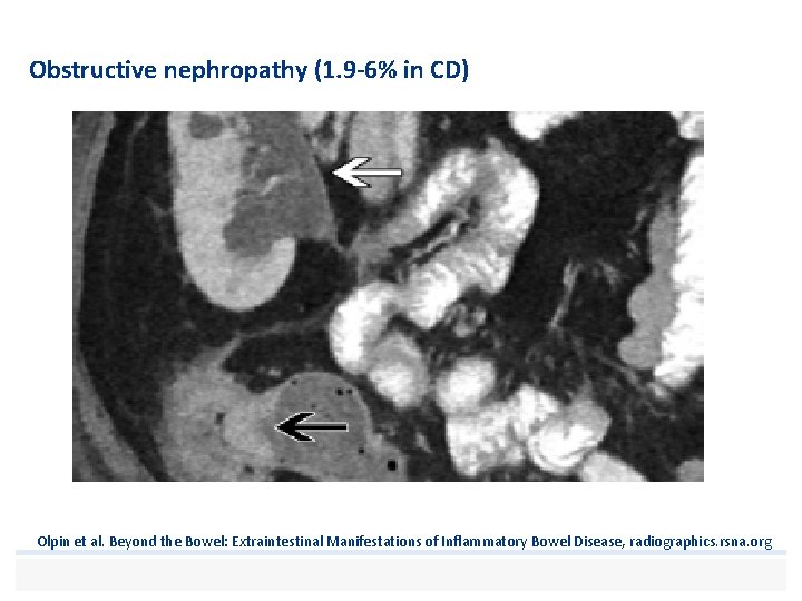 Obstructive nephropathy (1. 9 -6% in CD) Olpin et al. Beyond the Bowel: Extraintestinal