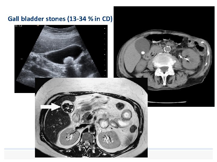 Gall bladder stones (13 -34 % in CD) 