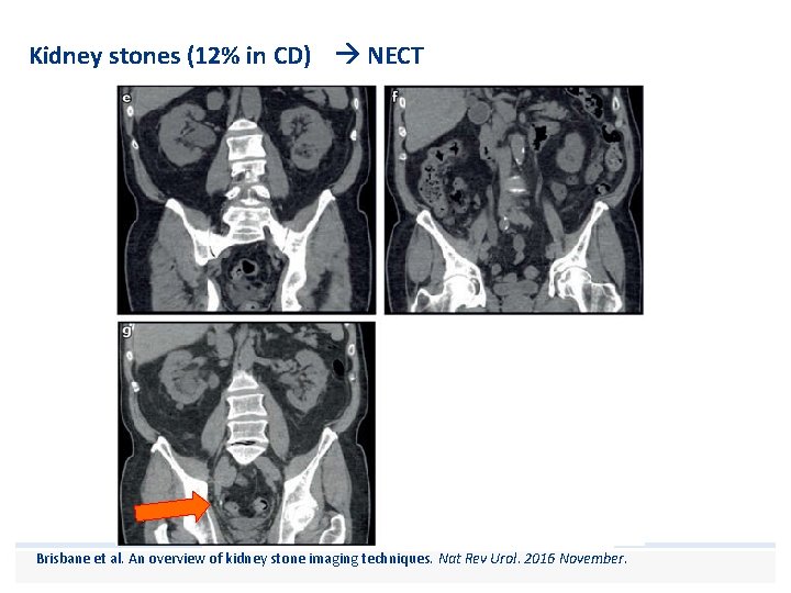 Kidney stones (12% in CD) NECT Brisbane et al. An overview of kidney stone