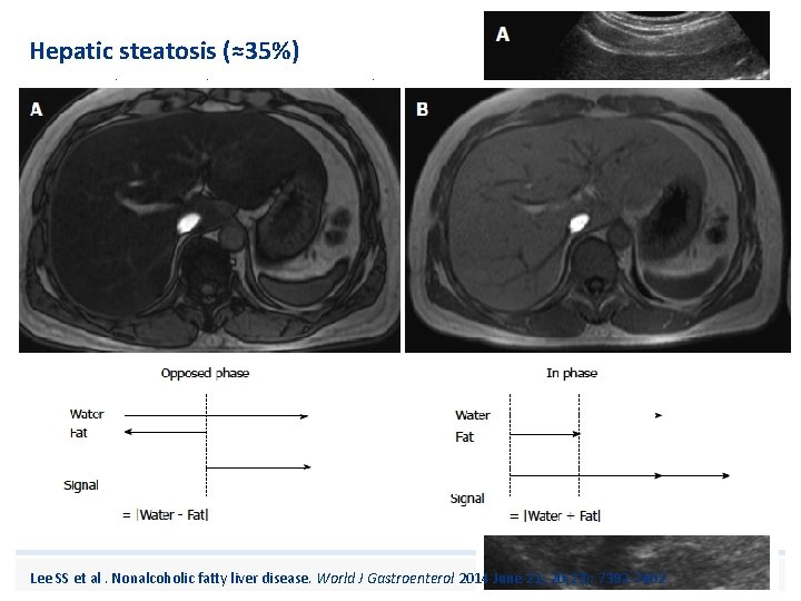 Hepatic steatosis (≈35%) • Due to chronic malnutrition, protein loss, corticosteroid therapy? Lee SS