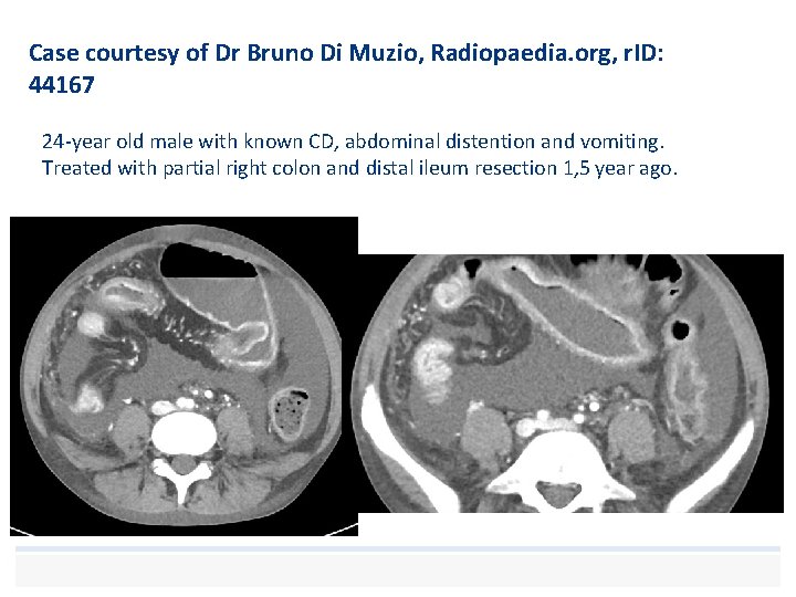 Case courtesy of Dr Bruno Di Muzio, Radiopaedia. org, r. ID: 44167 24 -year