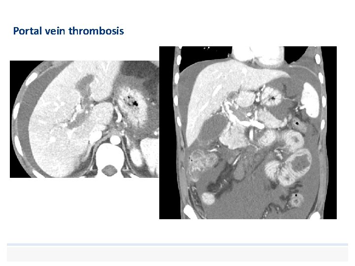 Portal vein thrombosis 