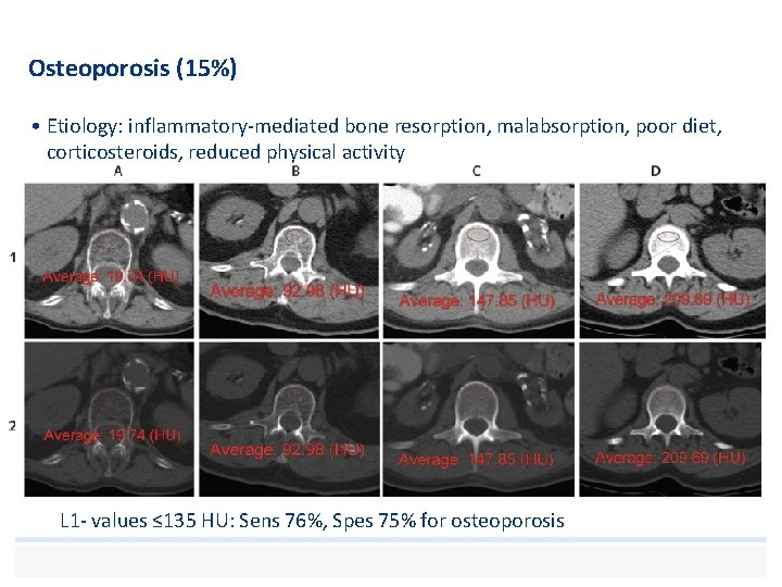 Osteoporosis (15%) • Etiology: inflammatory-mediated bone resorption, malabsorption, poor diet, corticosteroids, reduced physical activity