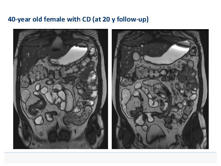 40 -year old female with CD (at 20 y follow-up) 