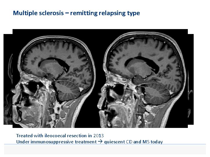 Multiple sclerosis – remitting relapsing type Treated with ileocoecal resection in 2013 Under immunosuppressive