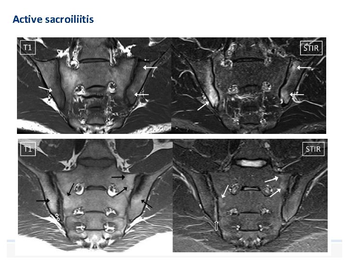 Active sacroiliitis 