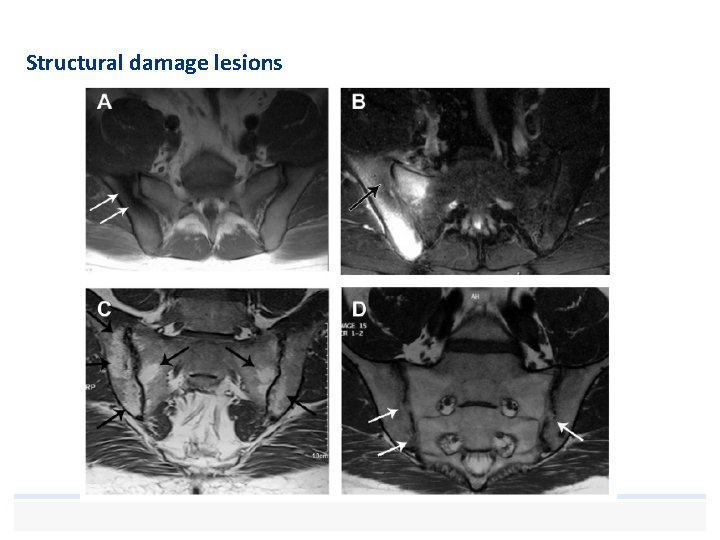 Structural damage lesions 