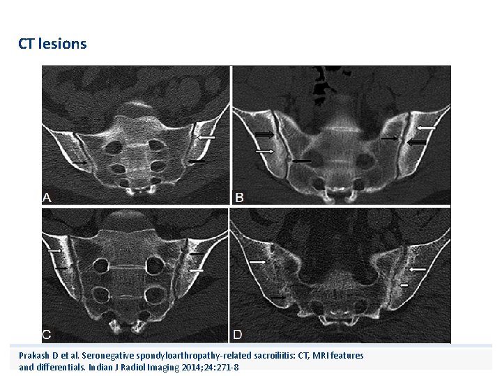 CT lesions Prakash D et al. Seronegative spondyloarthropathy-related sacroiliitis: CT, MRI features and differentials.
