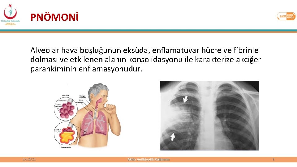 PNÖMONİ Alveolar hava boşluğunun eksüda, enflamatuvar hücre ve fibrinle dolması ve etkilenen alanın konsolidasyonu