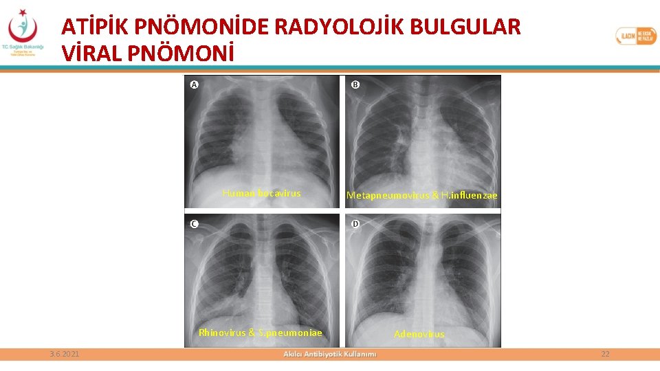 ATİPİK PNÖMONİDE RADYOLOJİK BULGULAR VİRAL PNÖMONİ 3. 6. 2021 Human bocavirus Metapneumovirus & H.