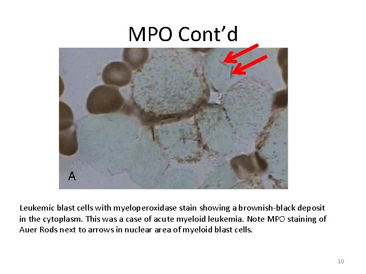 MPO Cont’d Leukemic blast cells with myeloperoxidase stain showing a brownish-black deposit in the