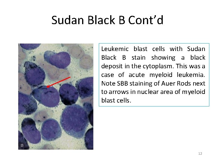 Sudan Black B Cont’d Leukemic blast cells with Sudan Black B stain showing a