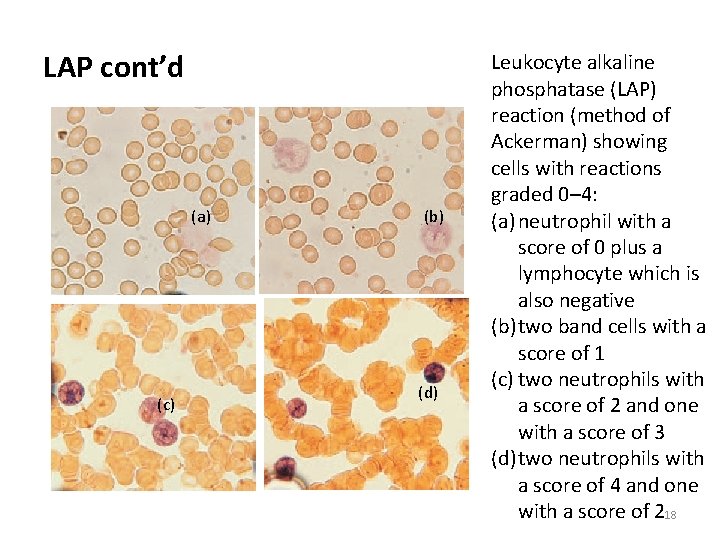 LAP cont’d (a) (c) (b) (d) Leukocyte alkaline phosphatase (LAP) reaction (method of Ackerman)