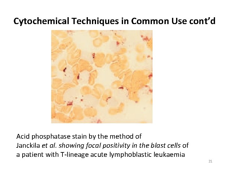 Cytochemical Techniques in Common Use cont’d Acid phosphatase stain by the method of Janckila