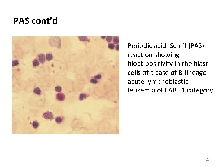 PAS cont’d Periodic acid–Schiff (PAS) reaction showing block positivity in the blast cells of