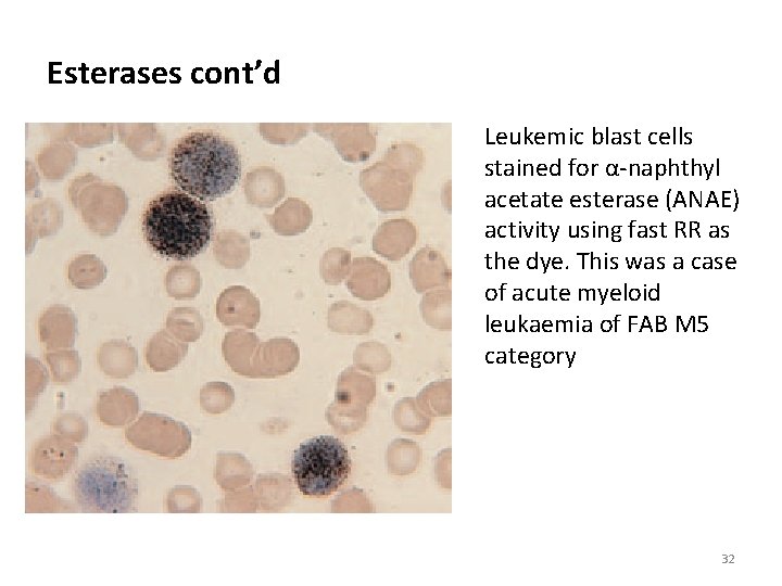 Esterases cont’d Leukemic blast cells stained for α-naphthyl acetate esterase (ANAE) activity using fast