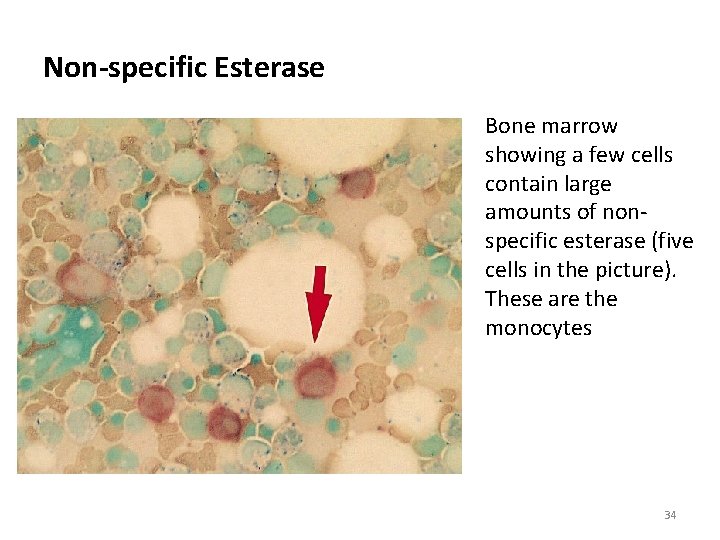 Non-specific Esterase Bone marrow showing a few cells contain large amounts of nonspecific esterase