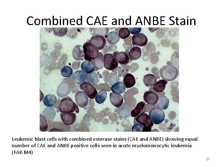 Combined CAE and ANBE Stain Leukemic blast cells with combined esterase stains (CAE and