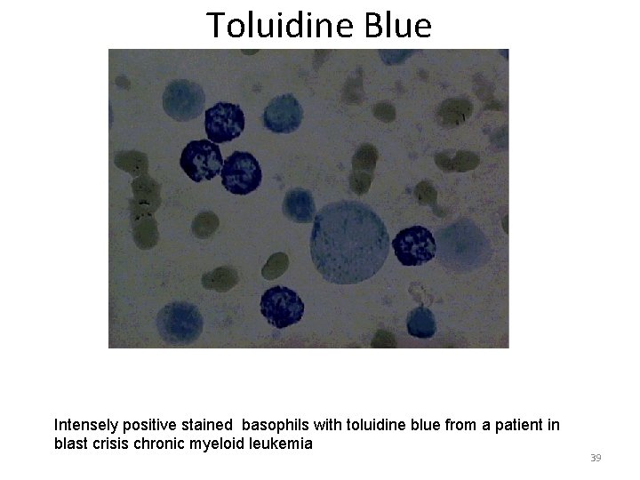 Toluidine Blue Intensely positive stained basophils with toluidine blue from a patient in blast