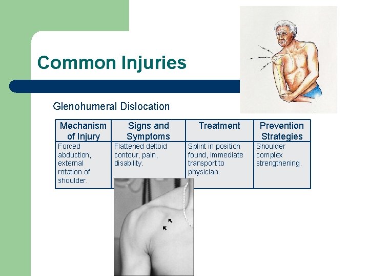 Common Injuries Glenohumeral Dislocation Mechanism of Injury Forced abduction, external rotation of shoulder. Signs