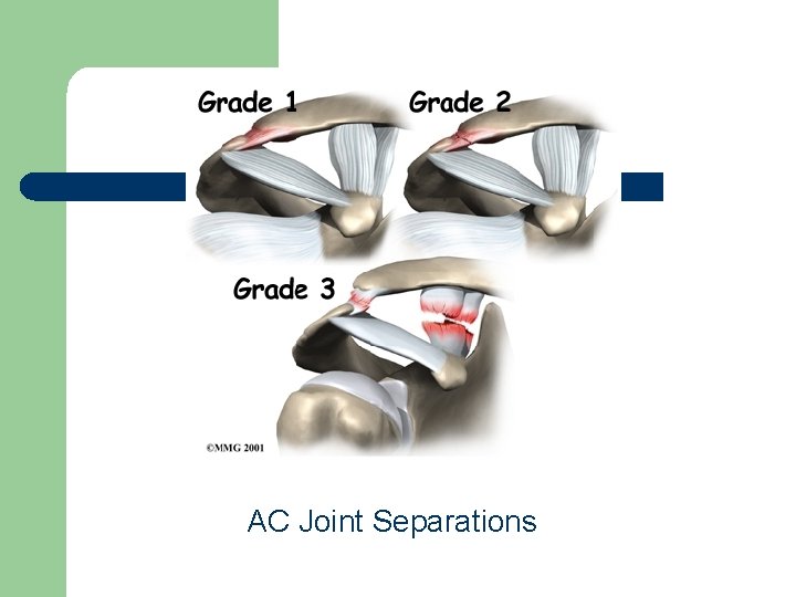 AC Joint Separations 