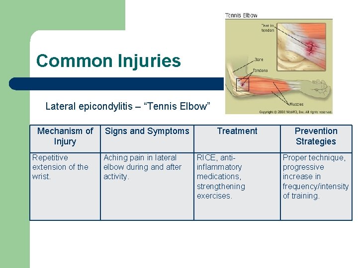Common Injuries Lateral epicondylitis – “Tennis Elbow” Mechanism of Injury Repetitive extension of the
