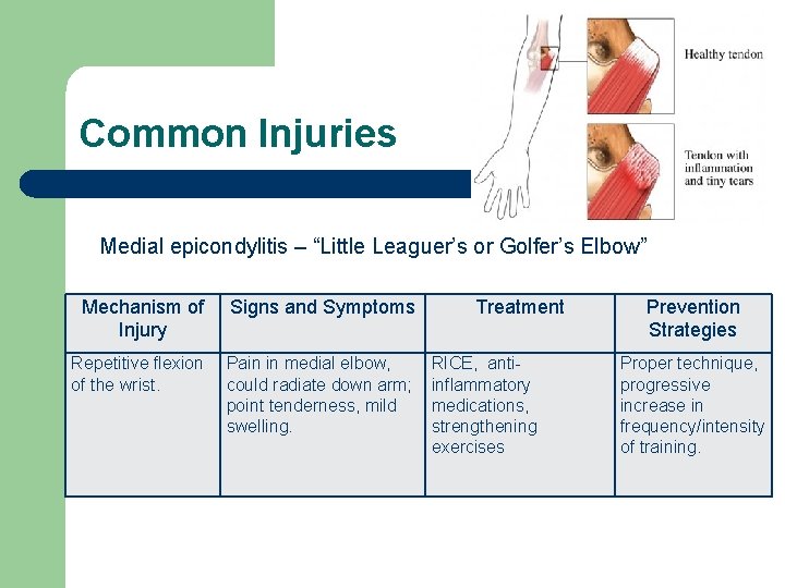 Common Injuries Medial epicondylitis – “Little Leaguer’s or Golfer’s Elbow” Mechanism of Injury Signs