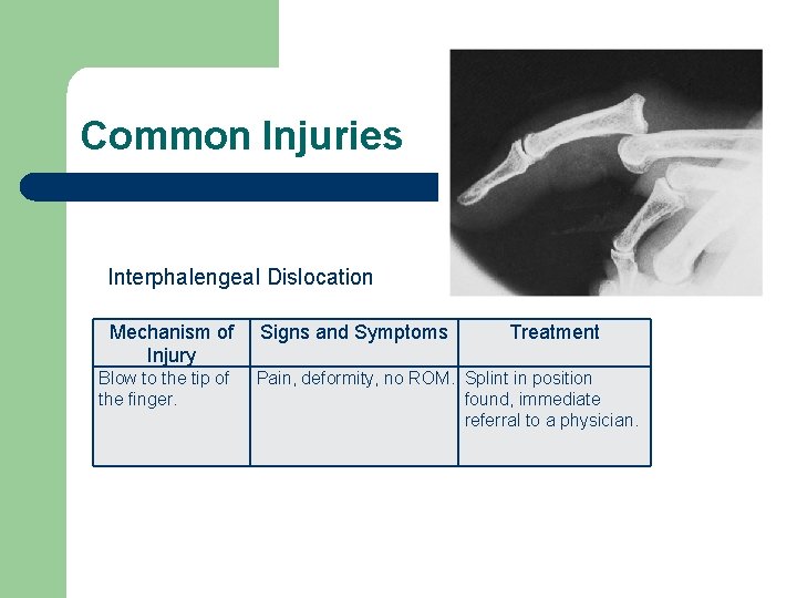 Common Injuries Interphalengeal Dislocation Mechanism of Injury Blow to the tip of the finger.