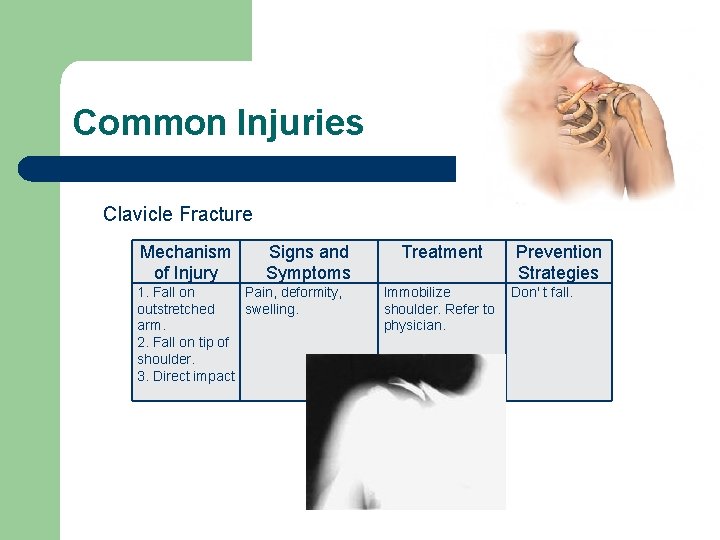 Common Injuries Clavicle Fracture Mechanism of Injury Signs and Symptoms 1. Fall on Pain,