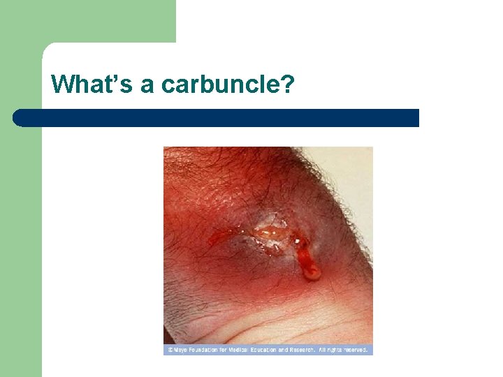 What’s a carbuncle? 