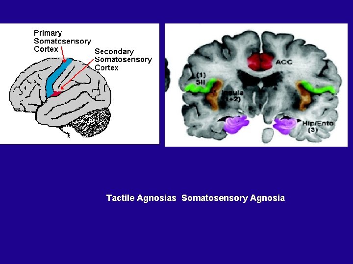 Tactile Agnosias Somatosensory Agnosia 