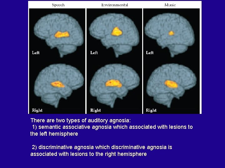 There are two types of auditory agnosia: 1) semantic associative agnosia which associated with