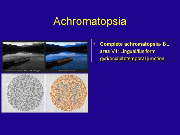 Achromatopsia • Complete achromatopsia- BL area V 4: Lingual/fusiform gyri/occipitotemporal junction 