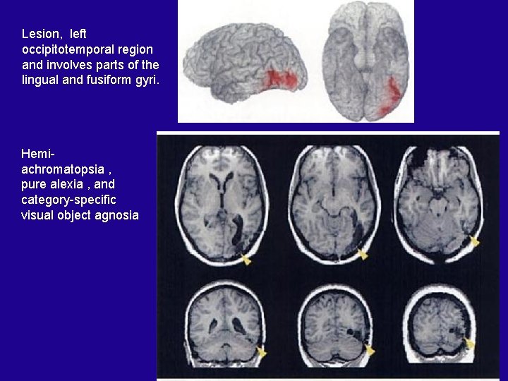 Lesion, left occipitotemporal region and involves parts of the lingual and fusiform gyri. Hemiachromatopsia