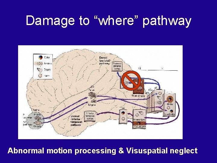 Damage to “where” pathway Abnormal motion processing & Visuspatial neglect 
