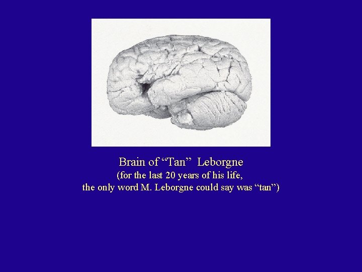 Brain of “Tan” Leborgne (for the last 20 years of his life, the only