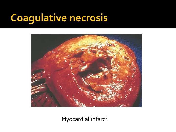 Coagulative necrosis Myocardial infarct 