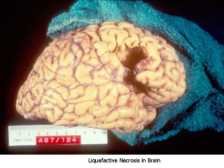 Liquefactive Necrosis in Brain 