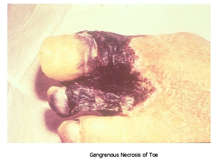 Gangrenous Necrosis of Toe 