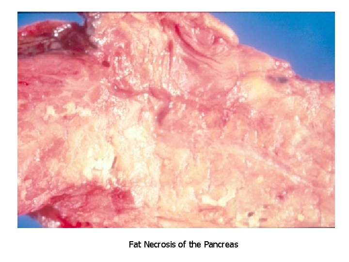 Fat Necrosis of the Pancreas 