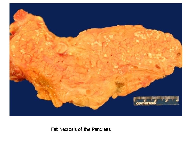 Fat Necrosis of the Pancreas 