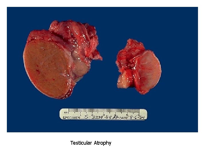 Testicular Atrophy 