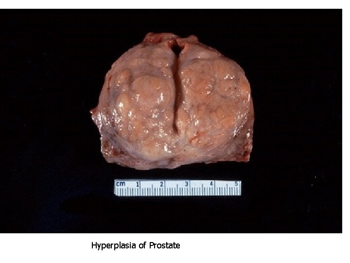 Hyperplasia of Prostate 