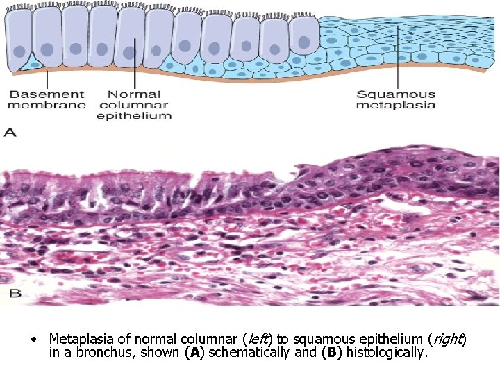  • Metaplasia of normal columnar (left) to squamous epithelium (right) in a bronchus,