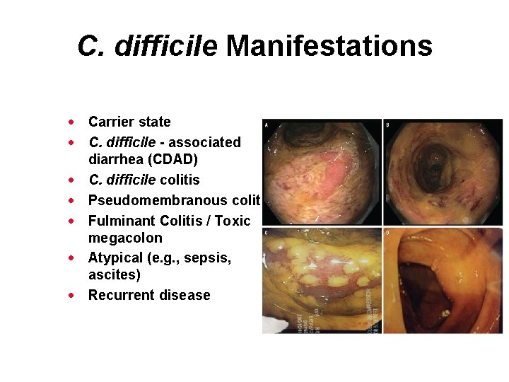 C. difficile Manifestations · Carrier state · C. difficile - associated diarrhea (CDAD) ·